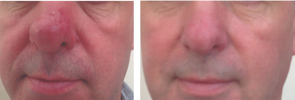 Rosacea