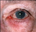 Rosacea  stadium 4 